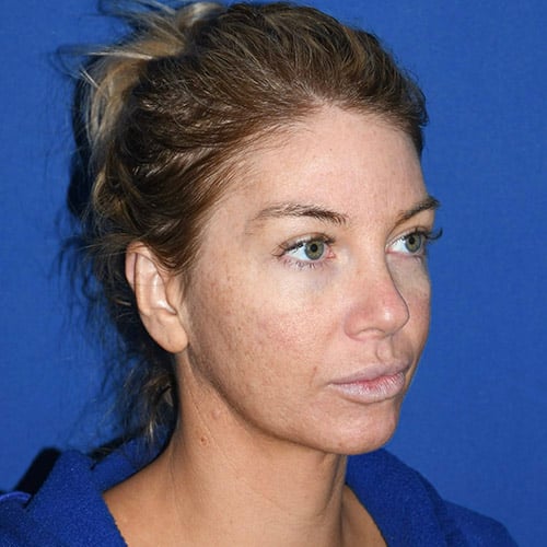 right oblique view after otoplasty and chin liposuction by dr papillion 12555