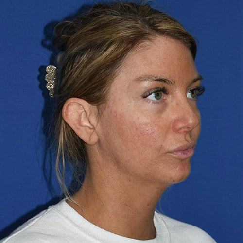 right oblique view before otoplasty and chin liposuction by dr papillion 12555
