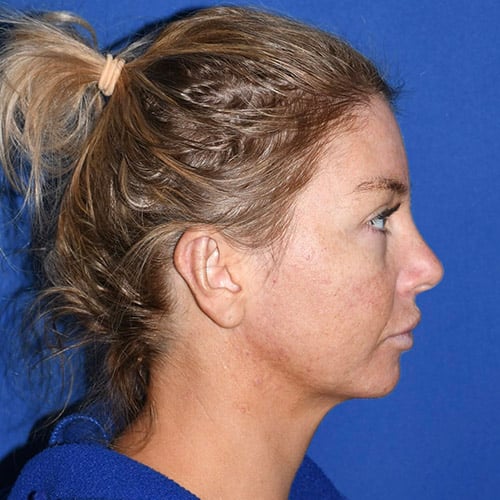 right side view after otoplasty and chin liposuction by dr papillion 12555