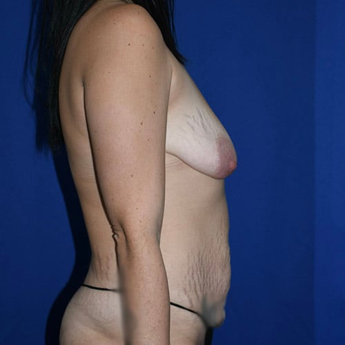right side view before abdominoplasty and breast lift by dr papillion 12536