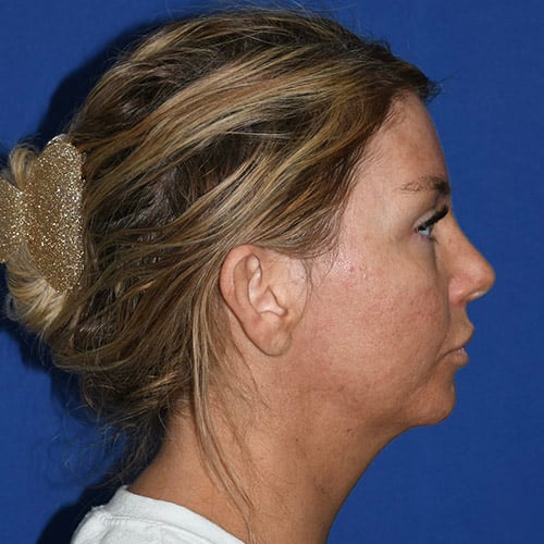 right side view before otoplasty and chin liposuction by dr papillion 12555
