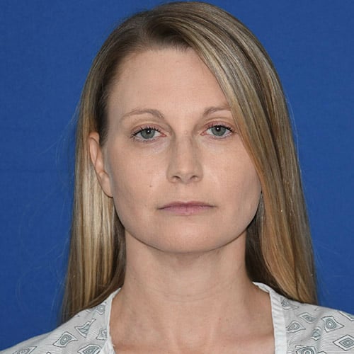 front view after chin liposuction by dr papillion 12865