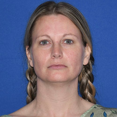 front view before chin liposuction by dr papillion 12865