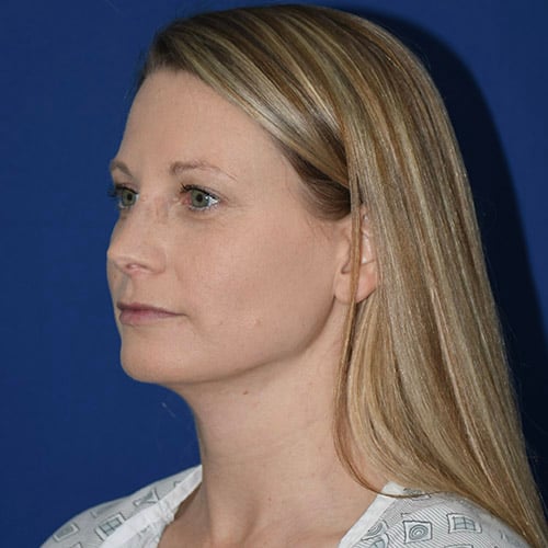 left oblique view after chin liposuction by dr papillion 12865