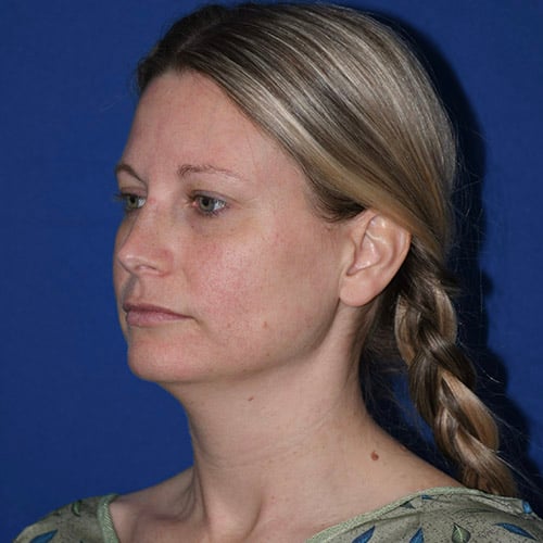 left oblique view before chin liposuction by dr papillion 12865