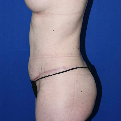 left side view after abdominoplasty by dr papillion 12865