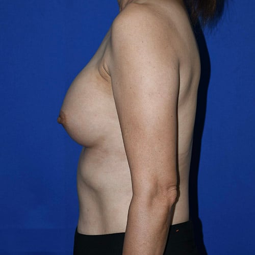 left side view after breast augmentation by dr papillion 12814