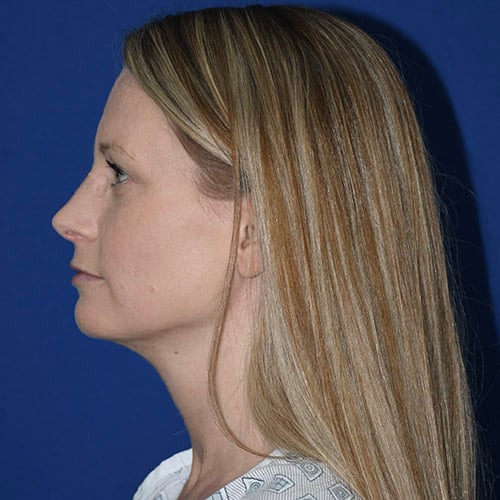 left side view after chin liposuction by dr papillion 12865