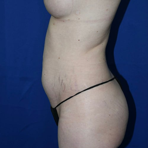 left side view before abdominoplasty by dr papillion 12865