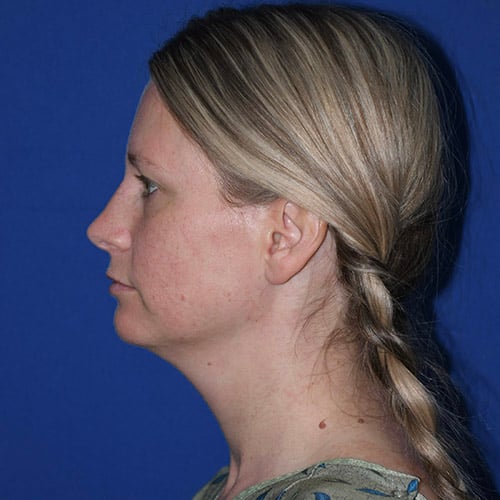 left side view before chin liposuction by dr papillion 12865