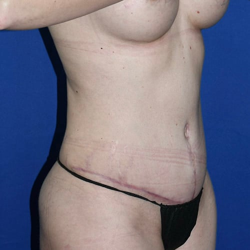right oblique view after abdominoplasty by dr papillion 12865
