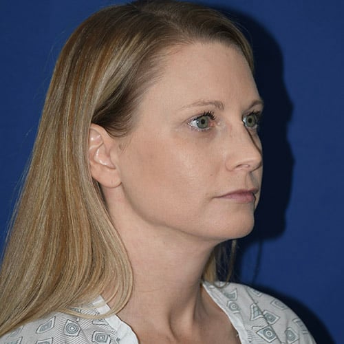 right oblique view after chin liposuction by dr papillion 12865