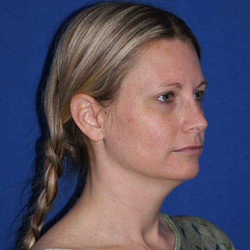 right oblique view before chin liposuction by dr papillion 12865