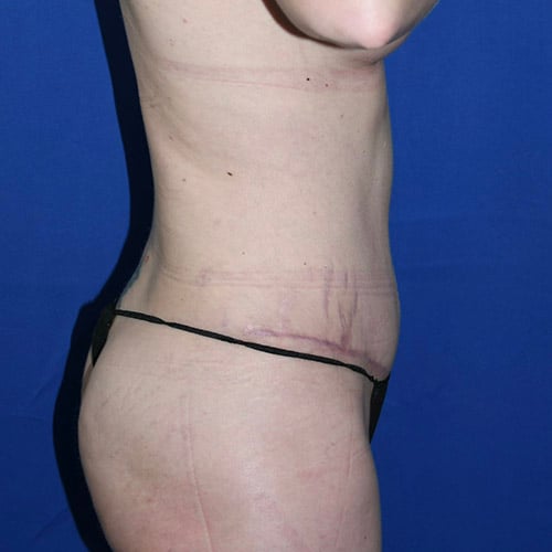 right side view after abdominoplasty by dr papillion 12865