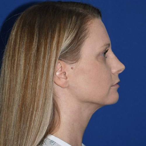 right side view after chin liposuction by dr papillion 12865