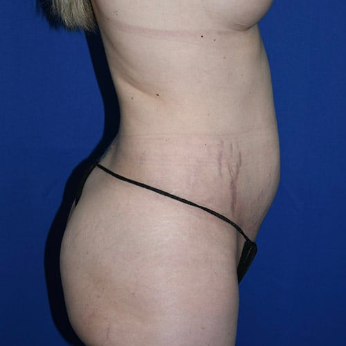 right side view before abdominoplasty by dr papillion 12865