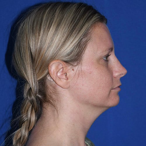 right side view before chin liposuction by dr papillion 12865
