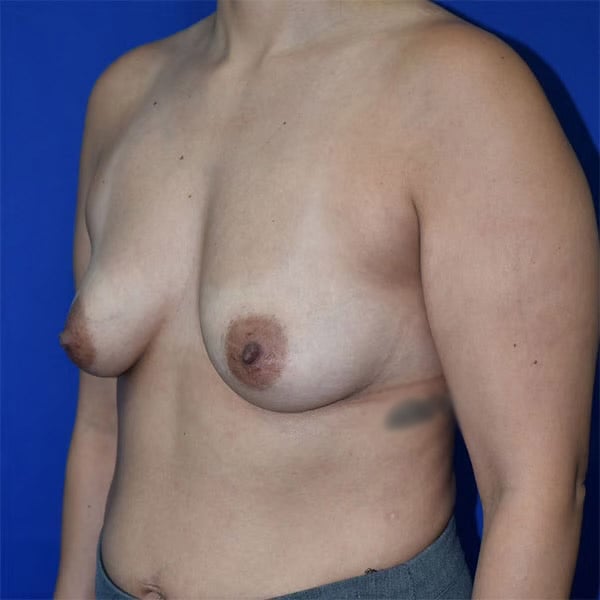 left oblique view before breast augmentation by dr papillion 12984