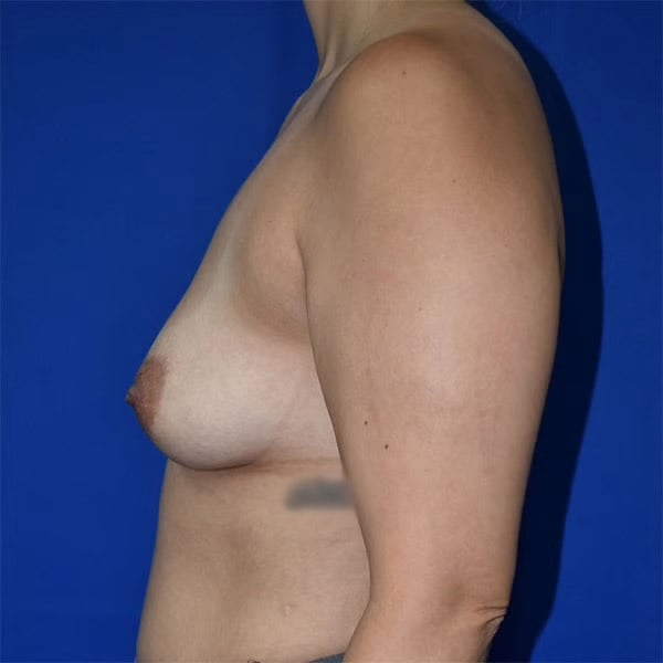 left side view before breast augmentation by dr papillion 12984